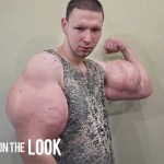 薬液を注射してハルクの様な二の腕を手に入れたロシア人青年