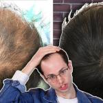 ハゲ・薄毛・AGAな男性が頭皮に入れ墨と自毛植毛を試した結果･･･